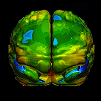 Single-photon Emission Computed Tomography educational video